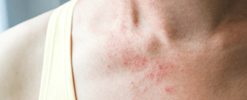 Young woman with rash on her neck