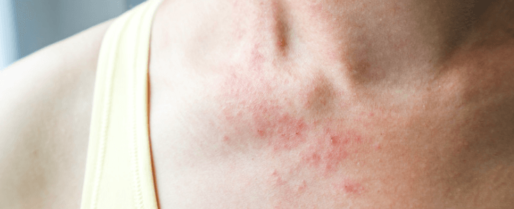 Young woman with rash on her neck